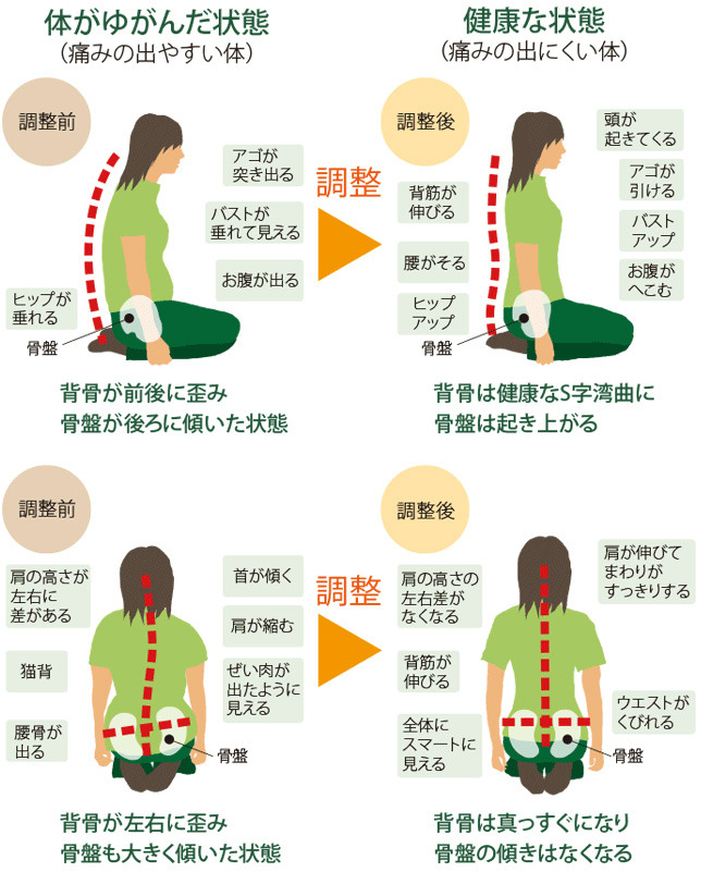 筋肉のバランスが崩れたカラダと正常のカラダの図